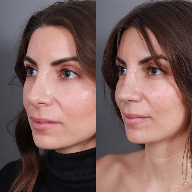 Revision Rhinoplasty Before & After
