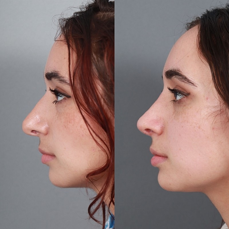 Before & After