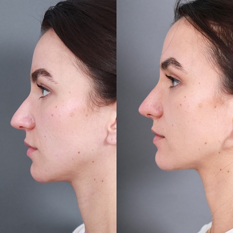 Before & After