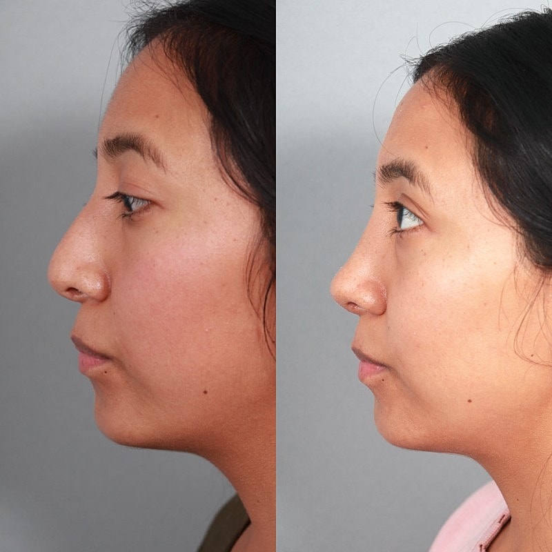 Before & After