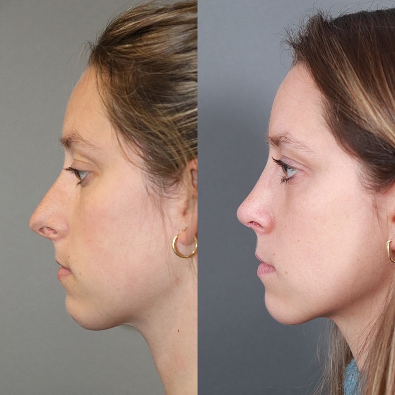 Before & After