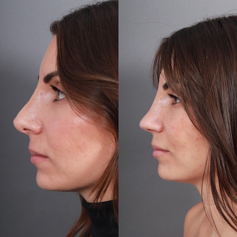 Revision Rhinoplasty Before & After