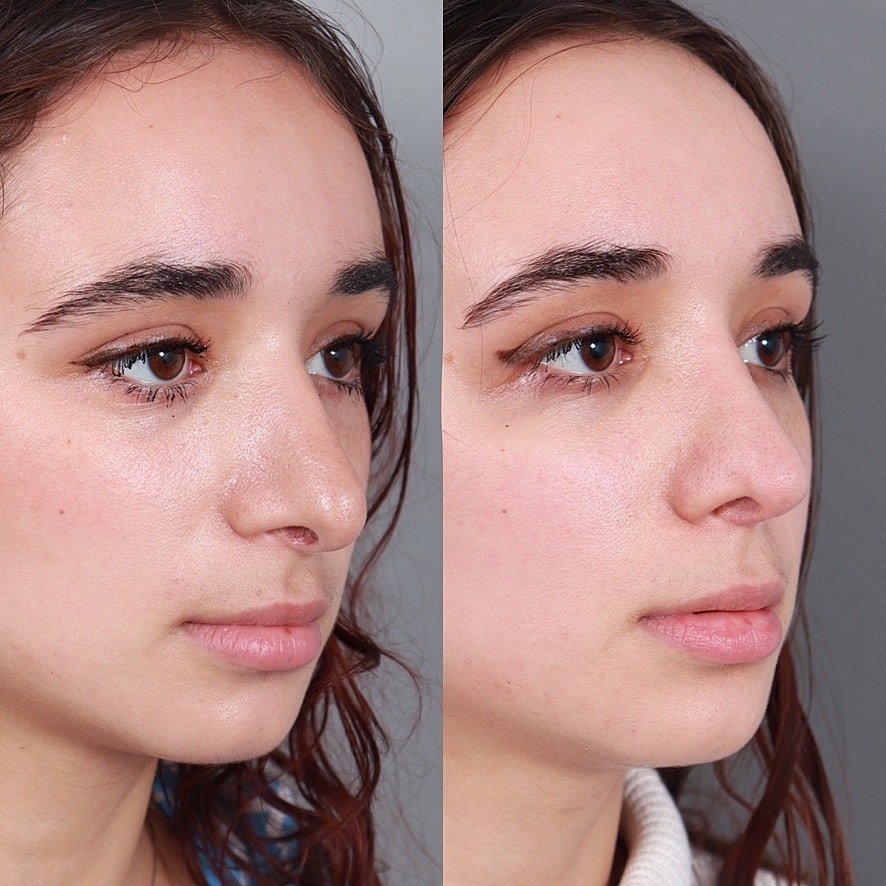 Before & After