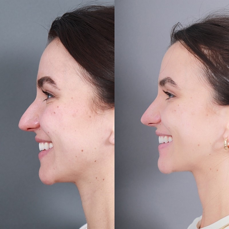 Before & After