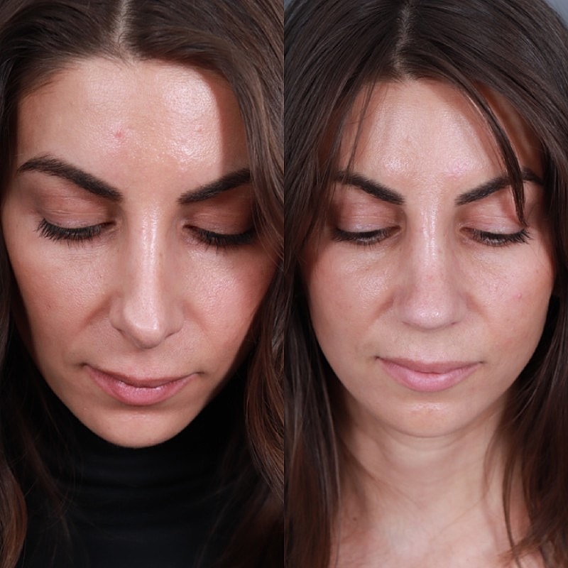 Revision Rhinoplasty Before & After