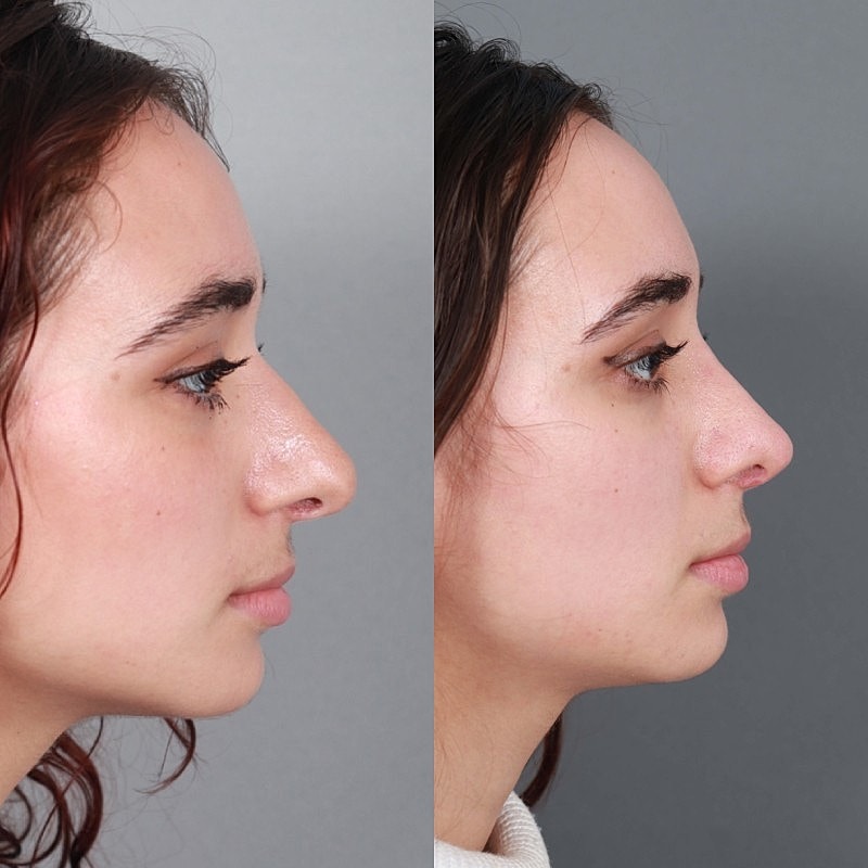 Before & After