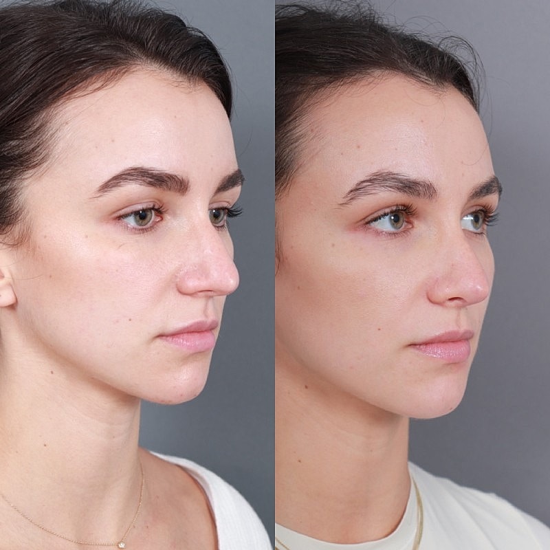Before & After