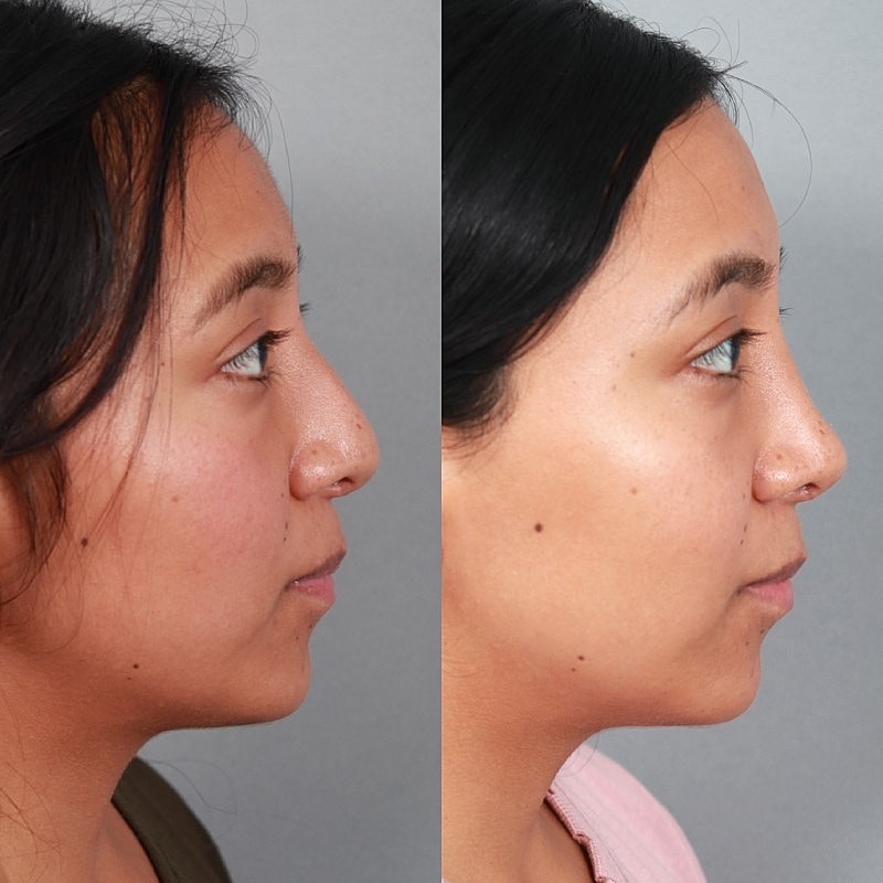 Before & After