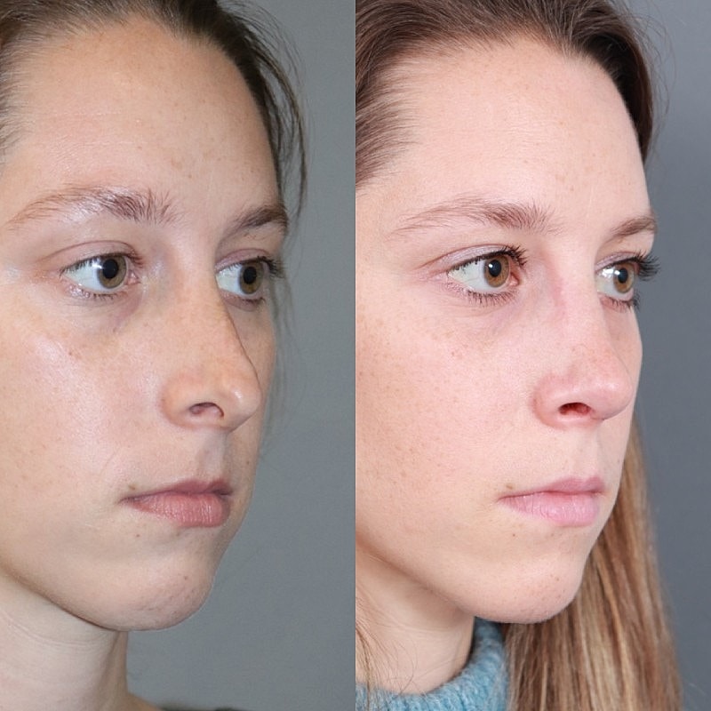 Before & After