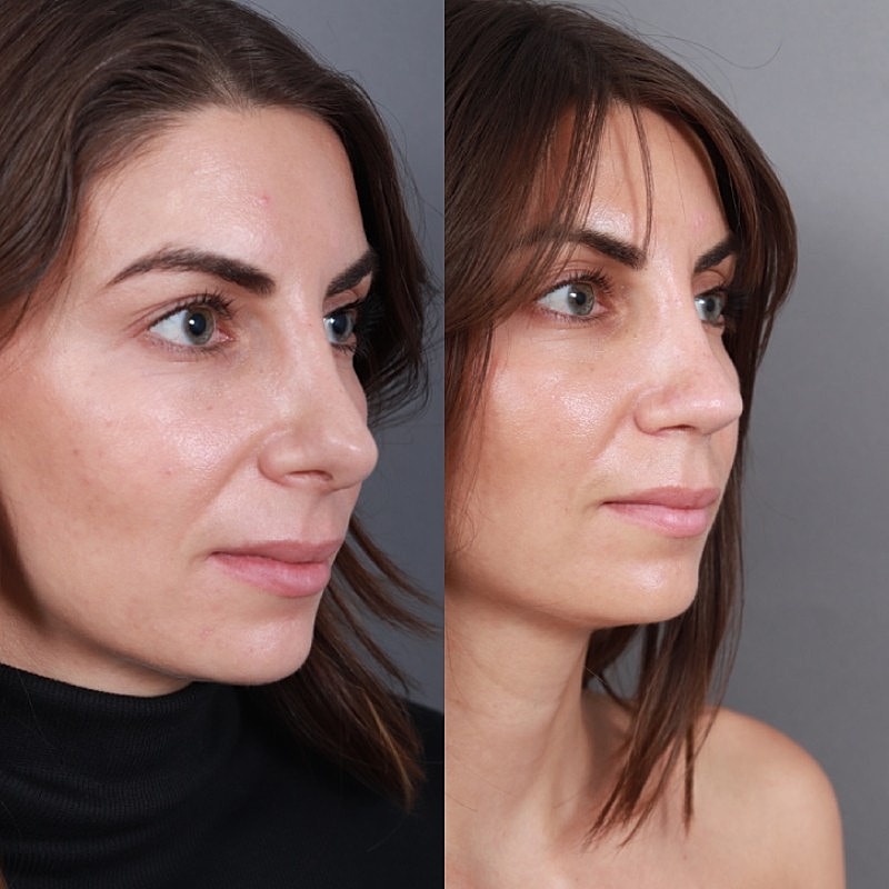 Revision Rhinoplasty Before & After