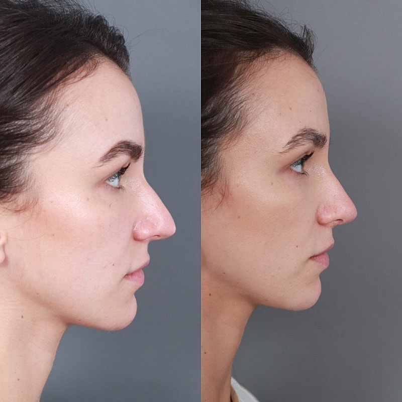 Before & After
