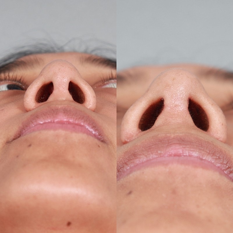 Before & After