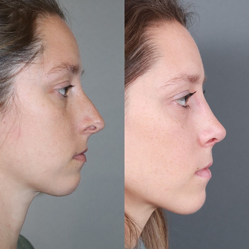 Before & After