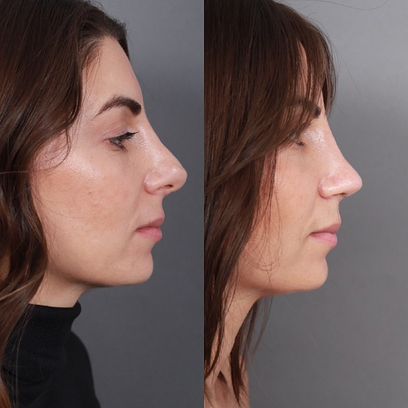 Revision Rhinoplasty Before & After