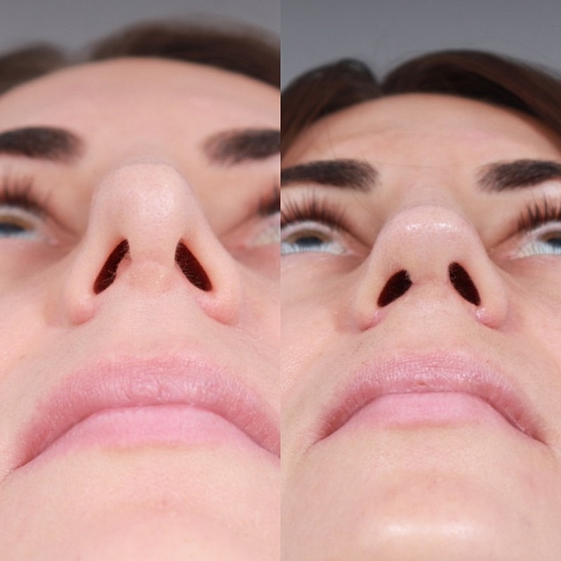 Revision Rhinoplasty Before & After