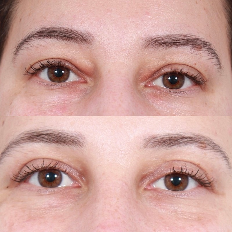 Blepharoplasty Before & After