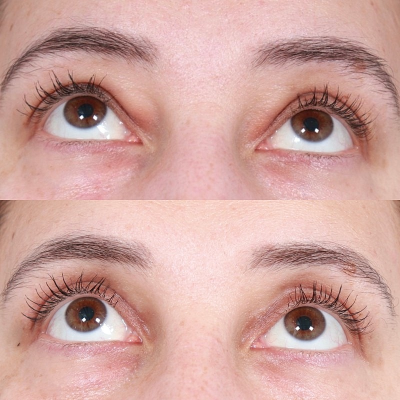Blepharoplasty Before & After