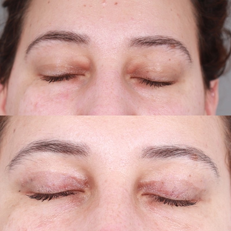 Blepharoplasty Before & After
