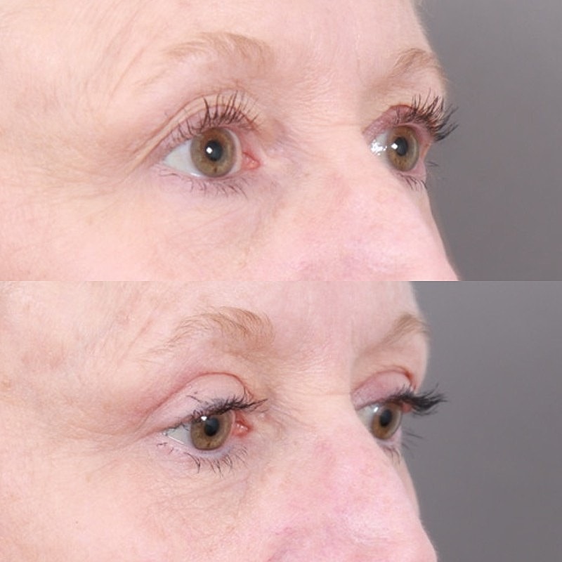 Blepharoplasty Before & After