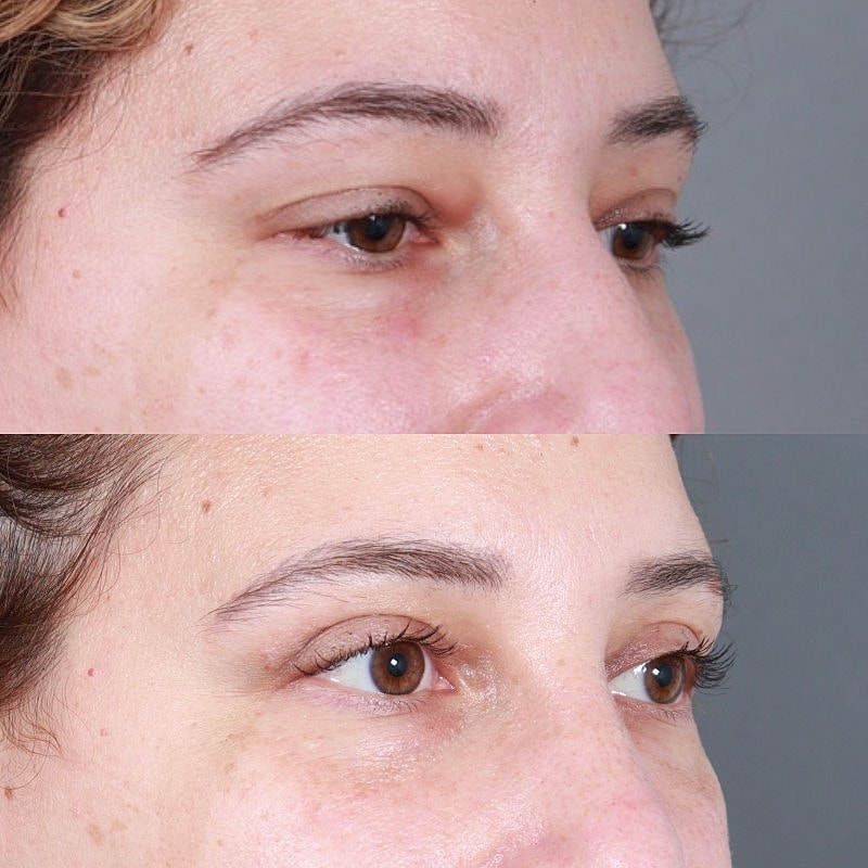 Blepharoplasty Before & After