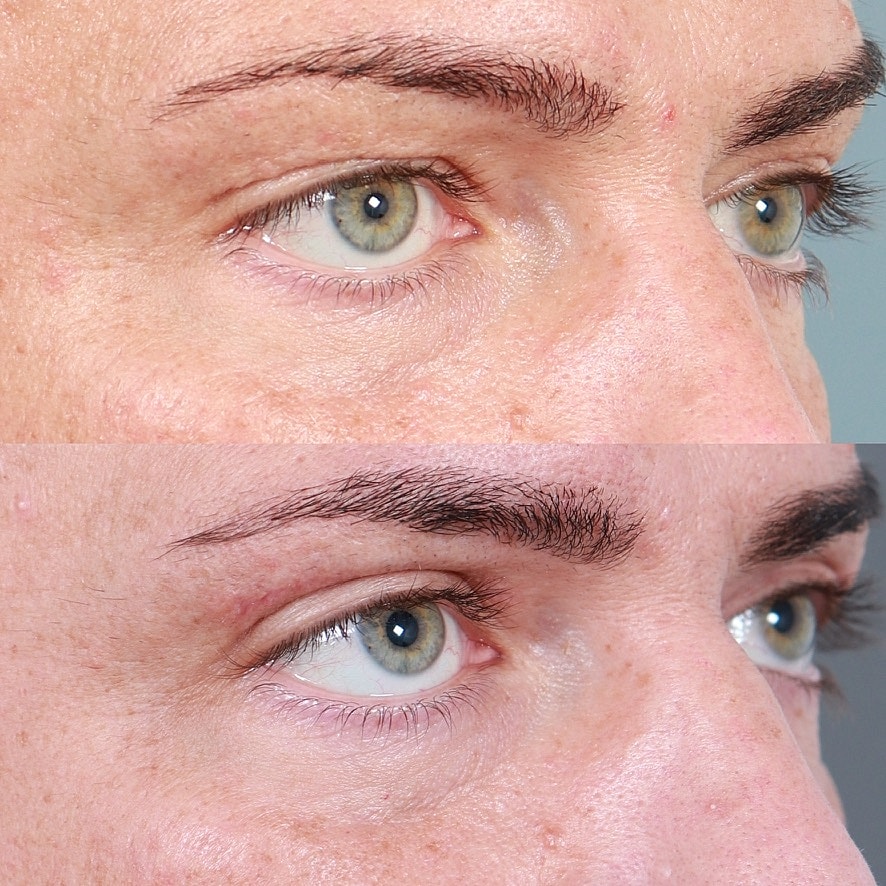 Blepharoplasty Before & After