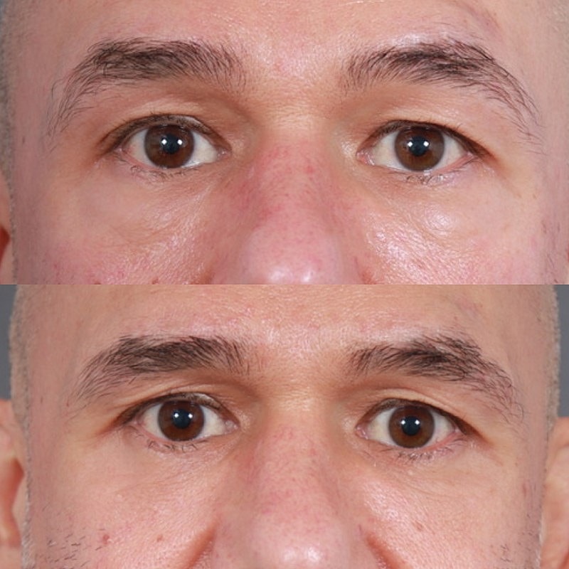 Blepharoplasty Before & After