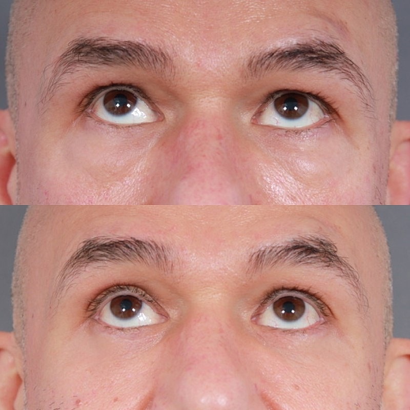 Blepharoplasty Before & After