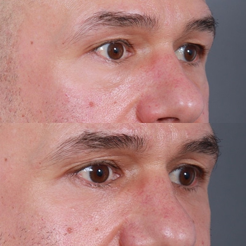 Blepharoplasty Before & After
