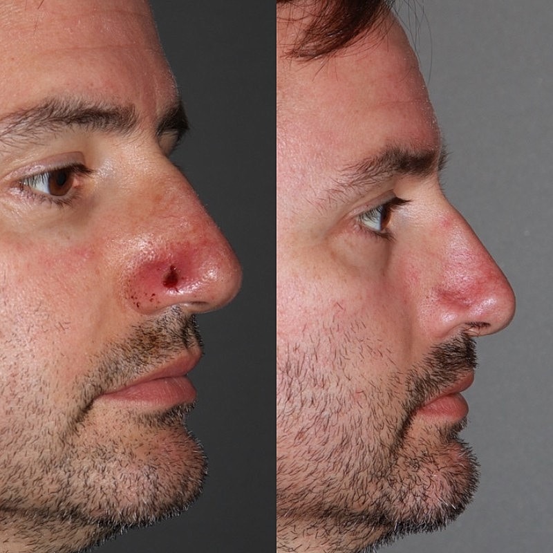 Mohs Before & After