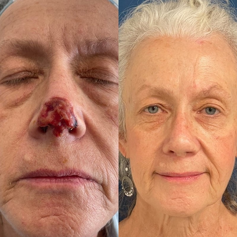Mohs Before & After