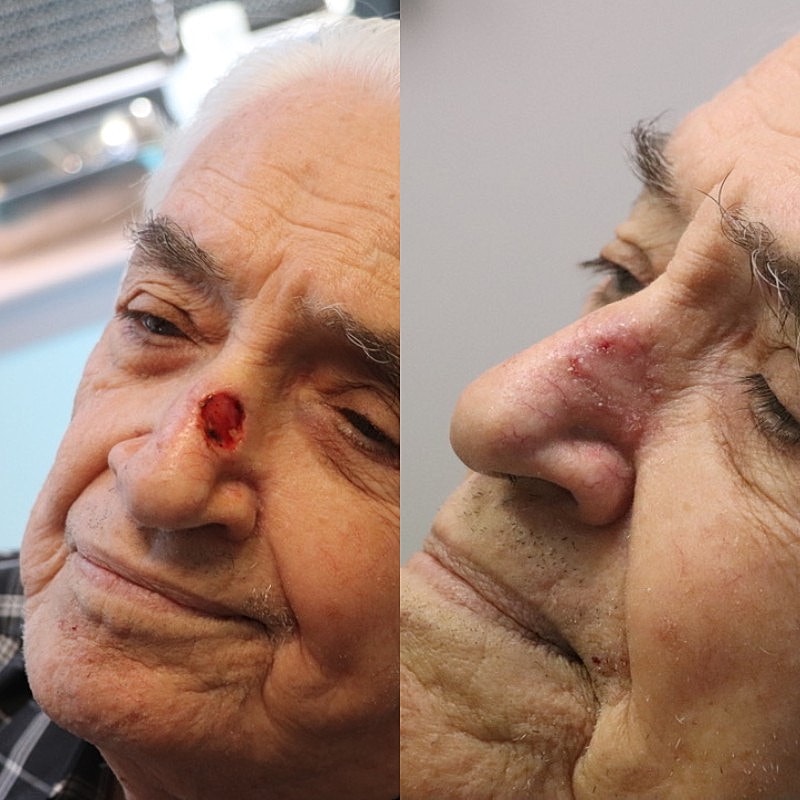 Mohs Before & After