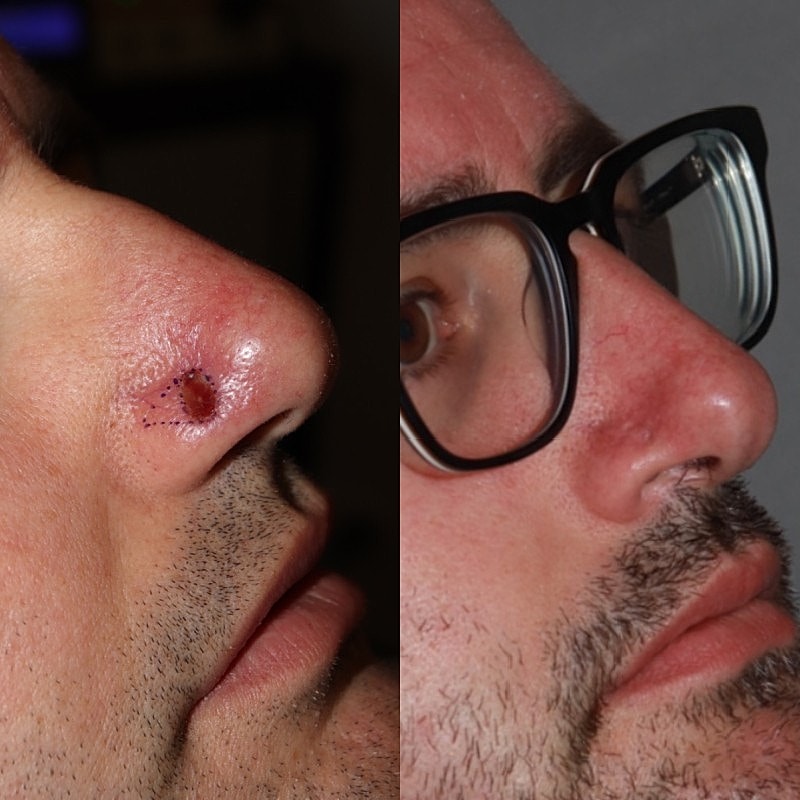 Mohs Before & After