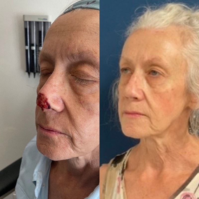 Mohs Before & After