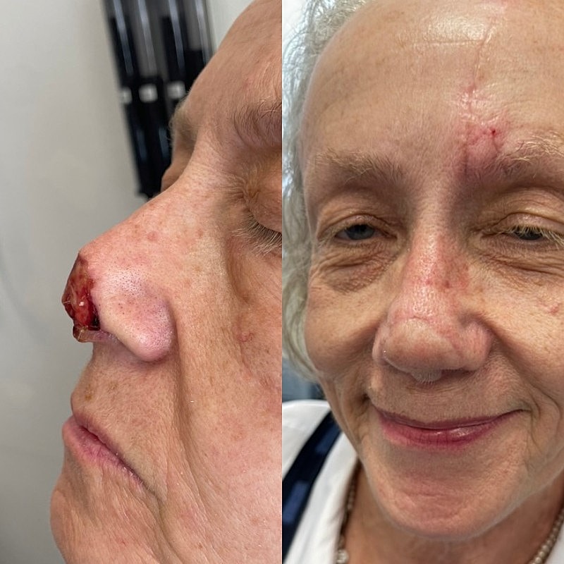 Mohs Before & After