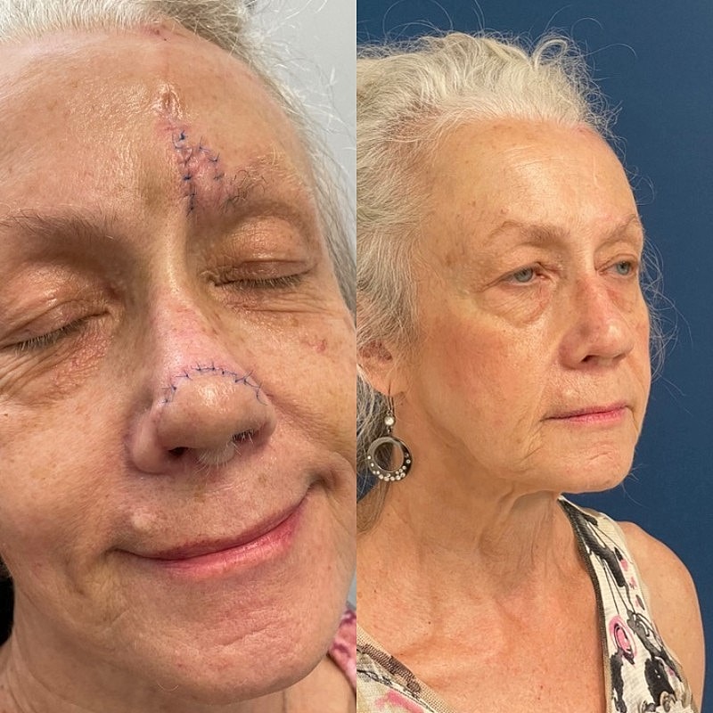 Mohs Before & After